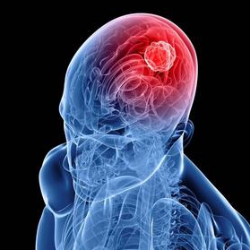 Doctors Developed New Technique to Treat Brain Cancer